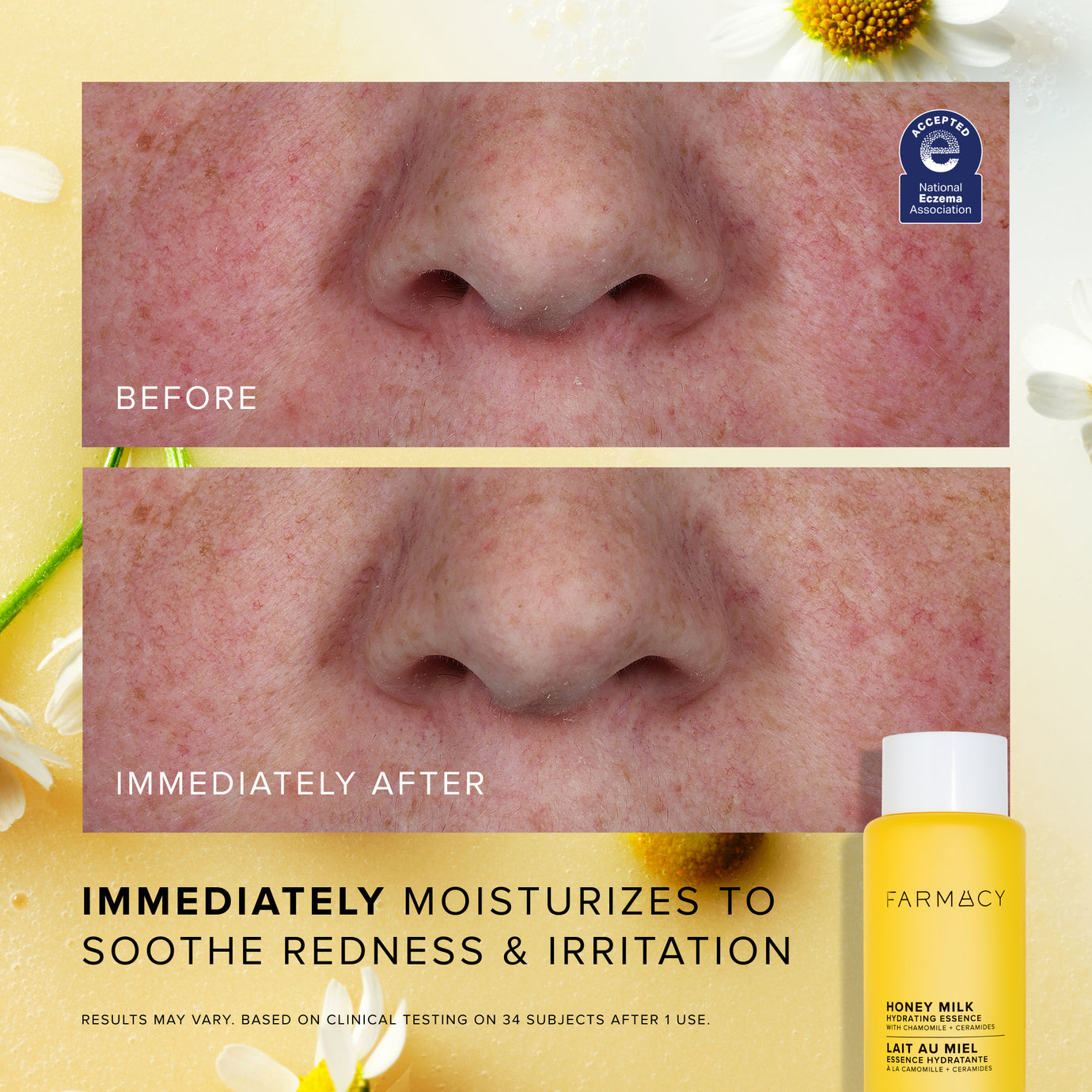 Before-and-immediately-after close-up showing soothed facial redness and irritation after using Farmacy Honey Milk Hydrating Essence 50 mL (1.7 fl. oz.)