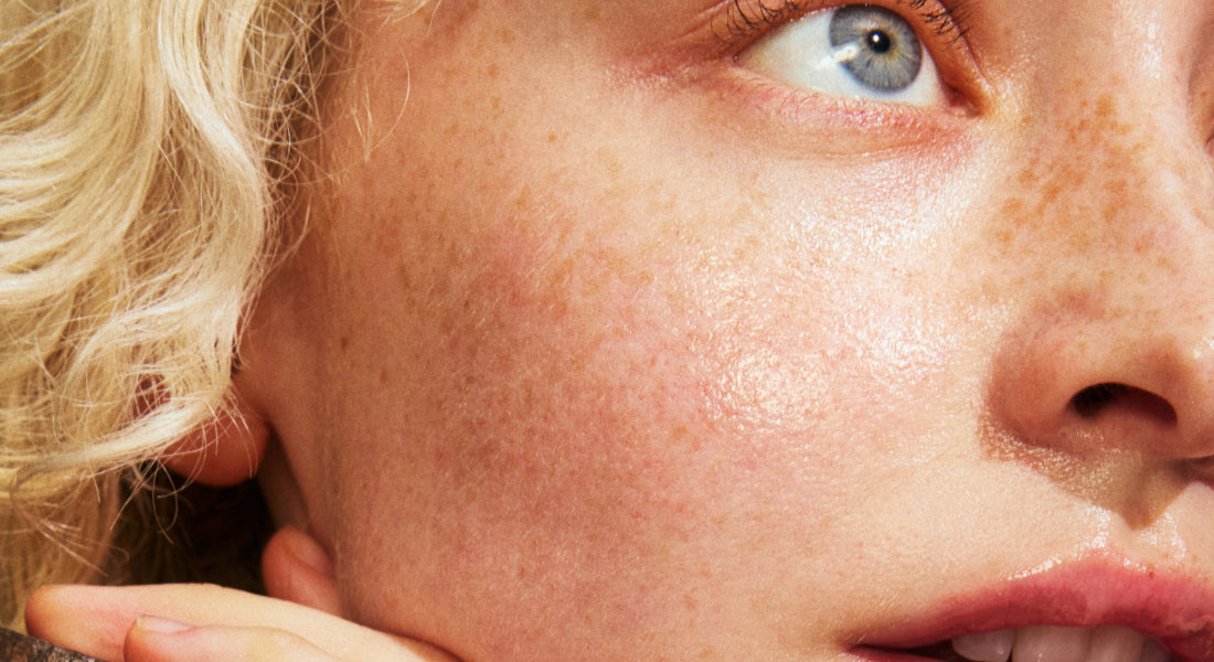 Close-up of a person's face with blonde hair and blue eyes, focusing on the skin texture.